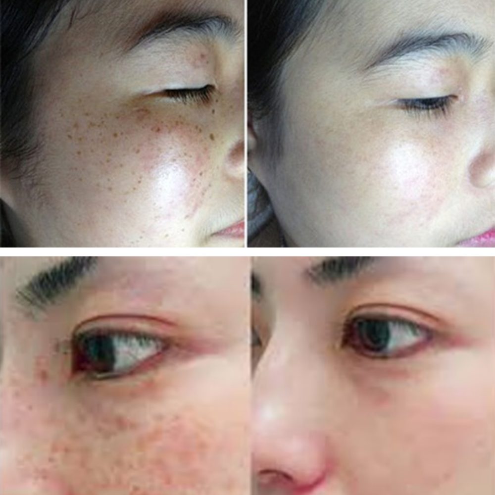 The Ultimate Guide to Finding the Best Melasma Oral Pills